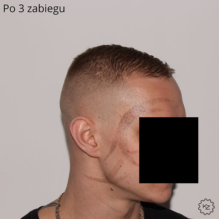laserowe usuwanie tatuażu